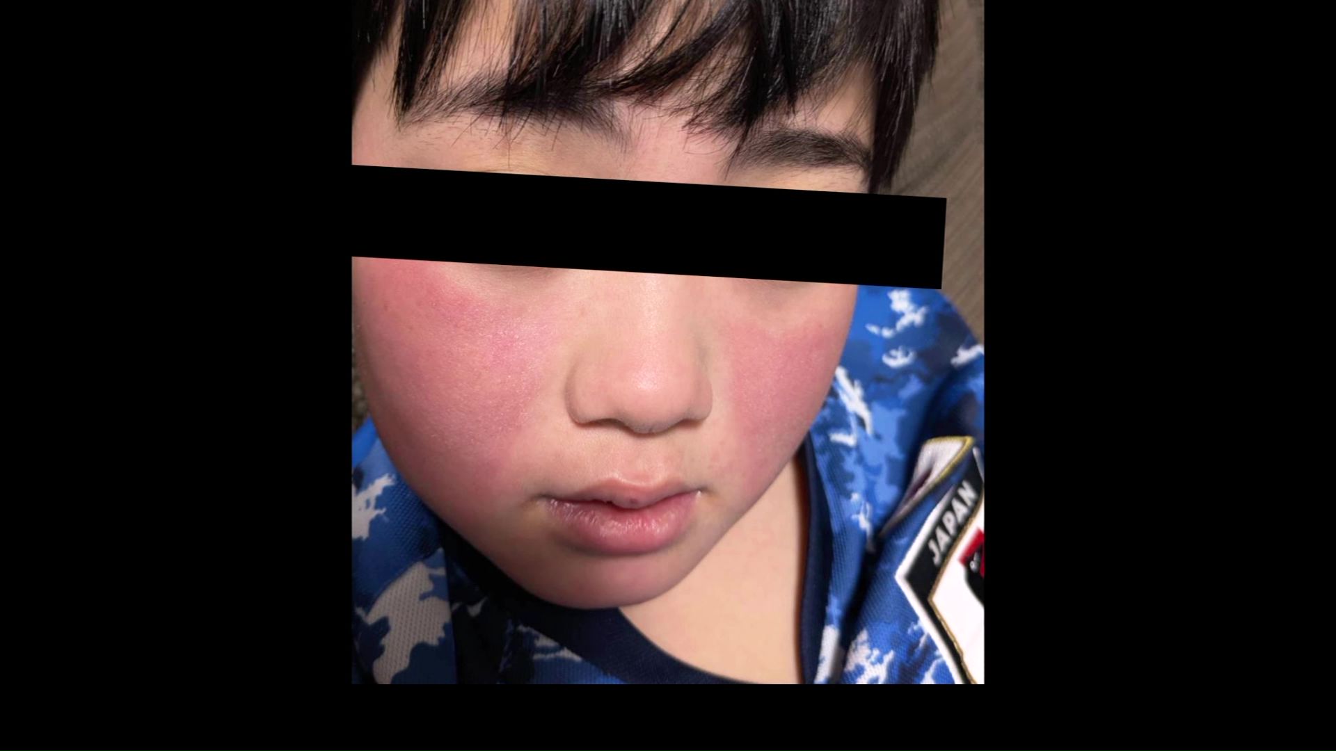 ほほが赤く染まる「リンゴ病」（提供：視聴者）