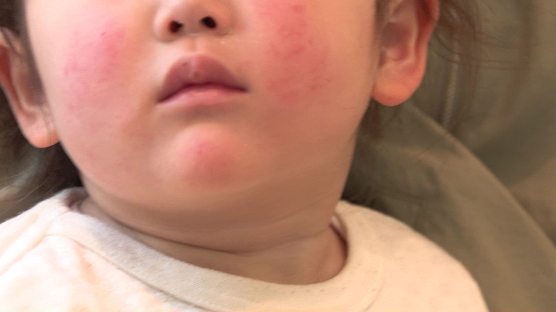 札幌市内の小児科を訪れた患者のほほも赤く…