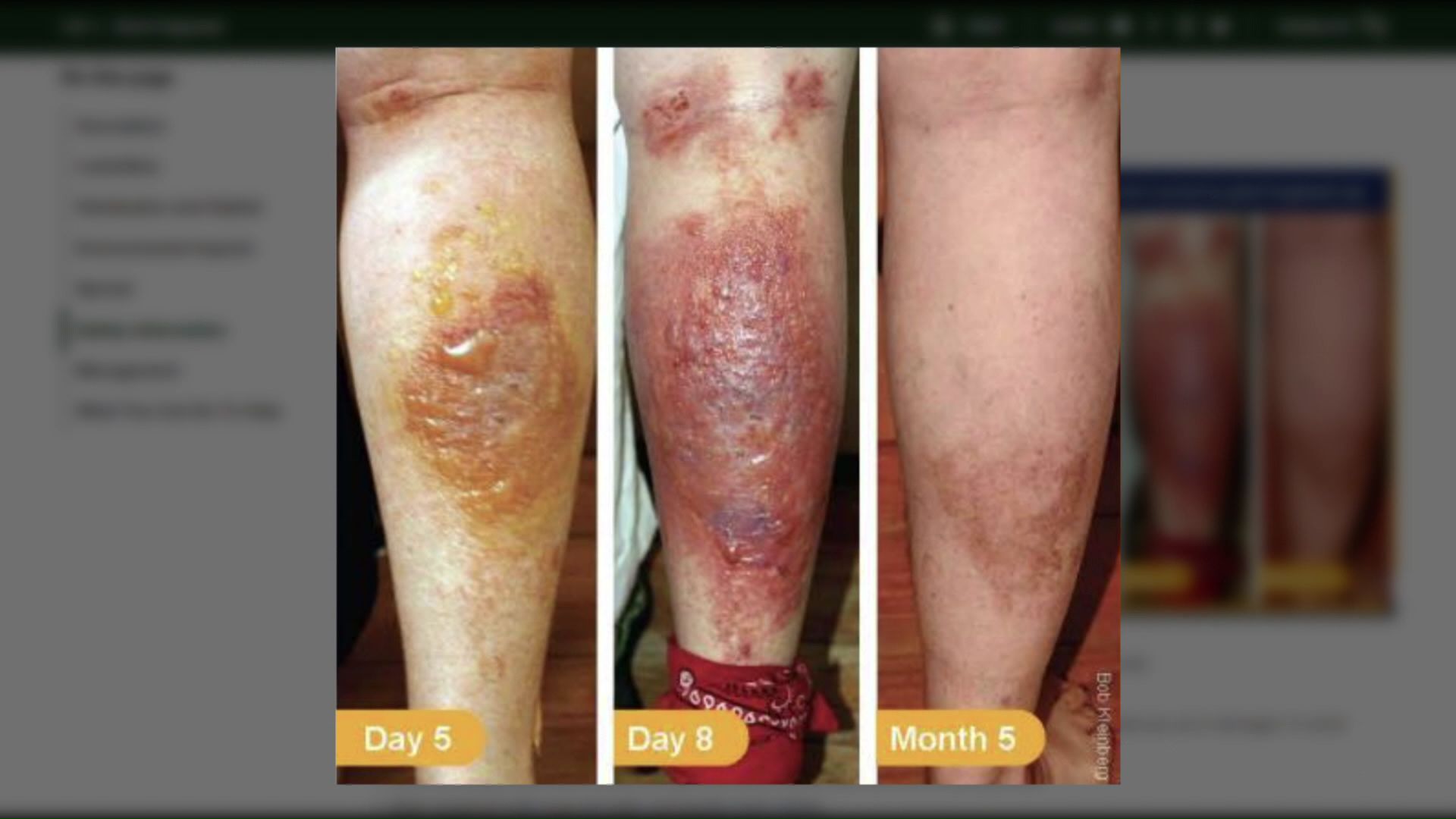 皮膚に樹液がついた状態で日光に当たると深刻な炎症を引き起こすおそれ